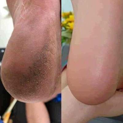 Dụng cụ cạo chân bằng thép không gỉ , để loại bỏ da chết , vết chai, , dụng cụ chà xát bàn chân, dao bào