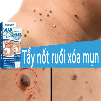 Kem Trị Mụn Cóc, Mụn Thịt, Mụn Cơm Hiệu Quả Sau 7 Ngày – Chiết Xuất Thảo Dược An Toàn 20g