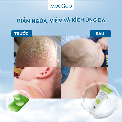Kem dưỡng cho bé Viêm da tiết bã, Vảy nến chiết xuất Dầu tràm Moogoo Úc thuần chay, lành tính