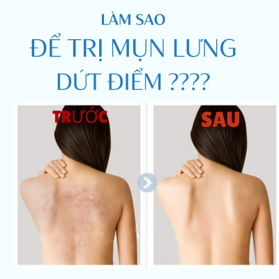 Phiên Bản Mini Xà Phòng Tắm Ngừa Mụn Vùng Lưng Pelican For Back Soap Bar 50 G