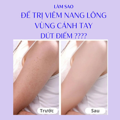 Xà Phòng Tắm Giúp Làm Mềm Chất Sừng, Đốm Nâu, Đen Trên Vùng Cánh Tay Pelican Baking Soda Bar Soap 135 G