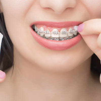 Sáp nha khoa giảm đau khi niềng răng, chỉnh nha - Vitis Orthodontic Wax (Vỉ 2 hộp)