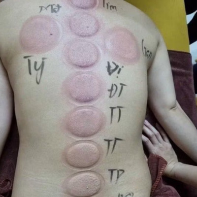 Bộ giác hơi ngải cứu cao cấp 6 cốc - VỪA GIÁC HƠI- VỪA CỨU NGẢI.giúp ôn ấm bài trừ hàn lạnh và lưu thông khi huyết